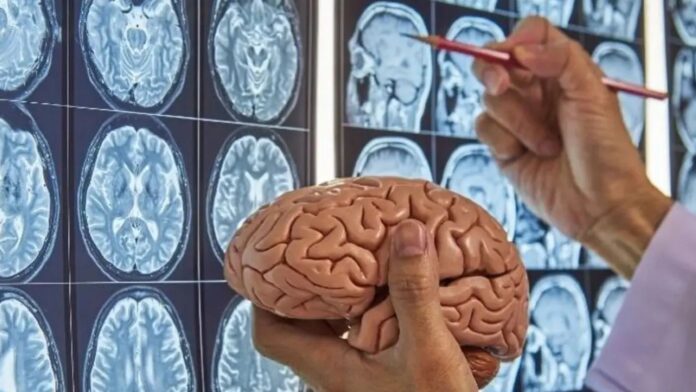 Microplásticos en el cerebro elevan el riesgo de tener Alzheimer