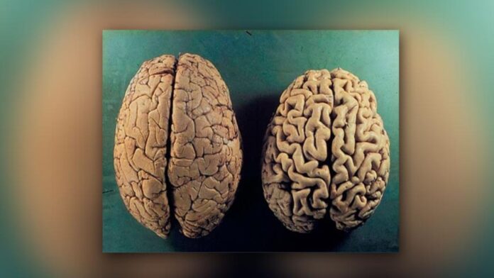 El estrés postraumático causa envejecimiento cerebral