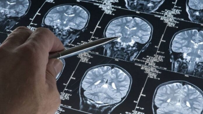 Conoce los nuevos avances contra la enfermedad de Alzheimer