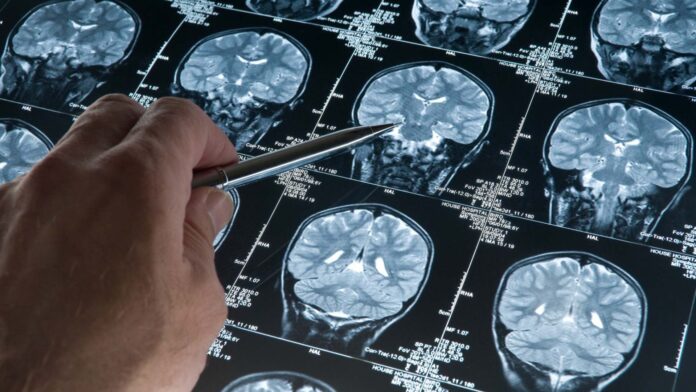 Modelo de IA logra detectar el Alzheimer 10 años antes